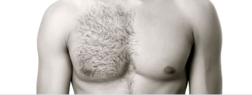 Male Full Body Electrolysis Beards Cheeks Back Shoulders